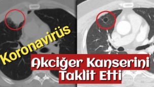 Covid-19, akciğer kanserini taklit etti