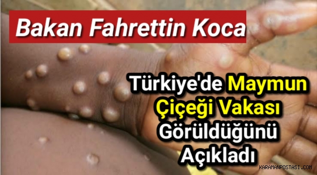 Sağlık Bakanı Fahrettin Koca, Türkiye'de maymun çiçeği vakası görüldüğünü açıkladı.