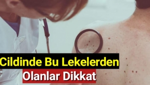 Cildinde Bu Lekelerden Olanlar Dikkat! Hemen Doktora Başvurun!