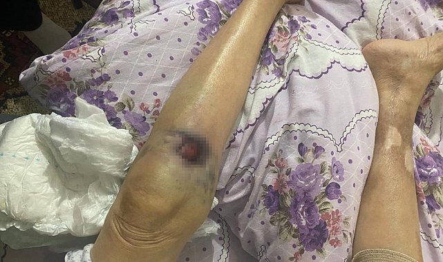 Ankara'da iki ay önce darp edildiği öne sürülen yaşlı kadın hastanede öldü
