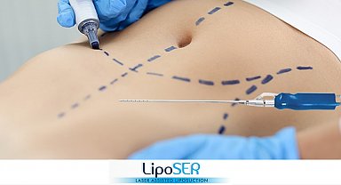 Lazer destekli Liposer ile fazla yağlardan kurtulmak mümkün
