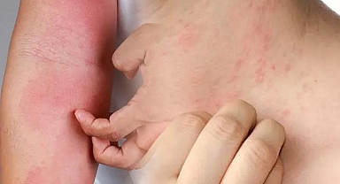 Vakalar her geçen gün katlanarak artıyor! Uzmanlar uyardı, 15 dakika bile yeterli: Bu belirtiler varsa...