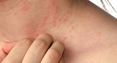 Çoğu hasta aylarca iyileşemiyor... Uzman isimden korkutan 'Uyuz' açıklaması! 'İlacı var ama SGK karşılamıyor'