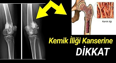 Erken teşhiste geç kalmayın..Kemik iliği kanseri nedir?