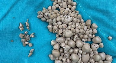 Tayvan'da kadının böbreklerinden 300 taş çıkarıldı