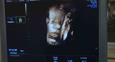 Türkiye'de 2021 yılında 32 bin olan HIV pozitif hasta sayısının, 2 kat fazla olduğu değerlendiriliyor