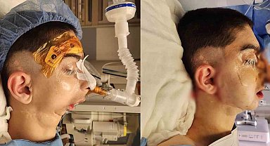 Doğuştan alt çenesi olmayan çocuğa başarılı operasyon: 17 yıl sonra normal yemek yiyebilecek