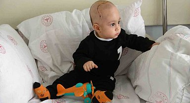 Kafatasında şekil bozukluğu olan 7 aylık bebek ameliyat edildi