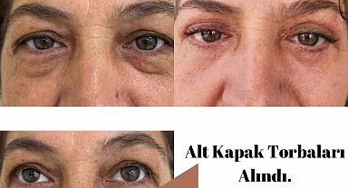Elmalı Devlet Hastanesi'nde göz kapağı estetik ameliyatları başladı
