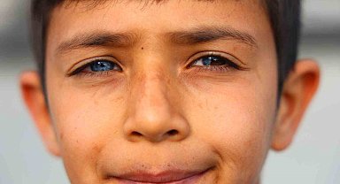 Hayata çift renk bakıyor, görenler hayrete düşüyor