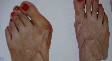 Topuklu ve sivri burun ayakkabı giyenler dikkat: Parmağınızın anatomisi bozulabilir