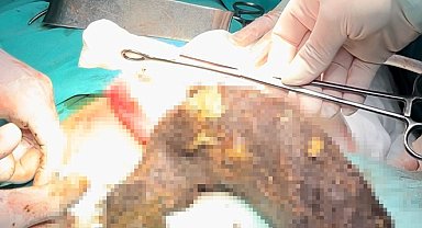 15 yıldır saç yeme alışkanlığı olan genç kızın karnından 2 kilogram kıl yumağı çıktı
