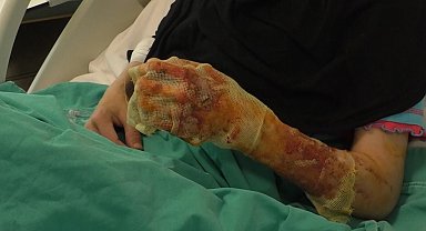 Mangal ateşine dezenfektan döken çift dehşeti yaşadı: "Eşim ateşi harlamak istedi, lütfen acele etmeyin"