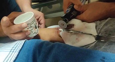 Acil serviste yüzük çıkarma operasyonu