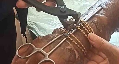 Kolu yanan kadının bilezikleri kesilerek çıkartıldı