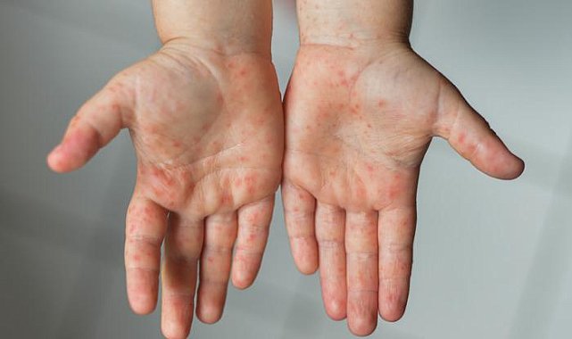 Uzman isimden kritik uyarı: Çocuklarda fazla görülüyor ama erişkinlere de bulaşabiliyor!