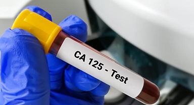 CA 125 nedir, neden yükselir? CA 125 kaç olursa tehlikeli? CA 125 testi ve CA 125 yüksekliği nedenleri
