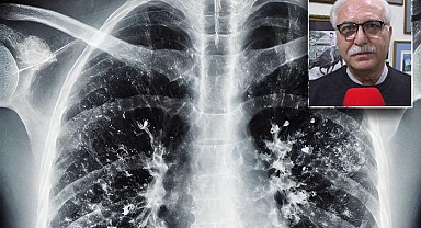 4 saat içinde tedaviye başlanmazsa ölümle sonuçlanabiliyor! Mevsimsel hastalıkların en ağırı buymuş! Griple karıştırmayın