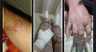 Hakkari'de lavabo açıcı patladı: İki kardeşin vücudu yandı! Üzerindeki kıyafetler tamamen eridi