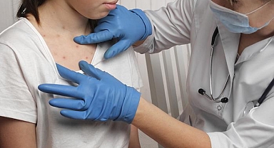 Kızamık geri döndü: Vaklar son 25 yılın en yüksek seviyesinde! Uzman isim İstanbul'da son durumu açıkladı