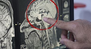 Türkiye'de sağlıkta bir ilk! Kapalı yöntemle beyindeki tümör alındı: