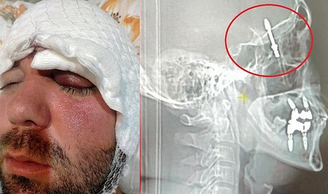 Bursa'da inanılmaz olay: Dişçiye gitti, hayatı kabusa döndü! Neredeyse ölüyordu