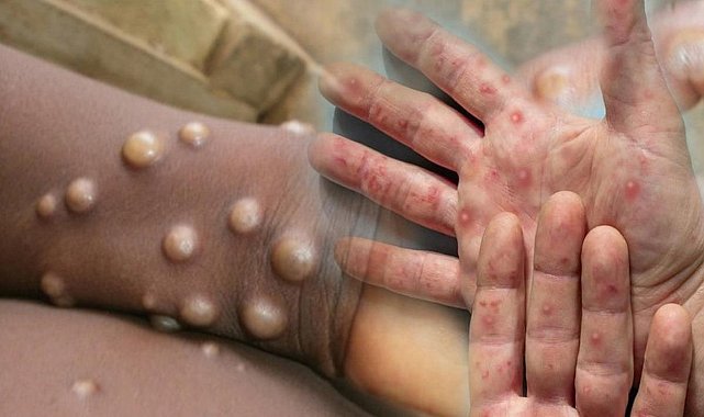 DSÖ'den M çiçeği virüsü uyarısı: Salgın kıtayı aştı! 'Kontrol altına alınmalı'