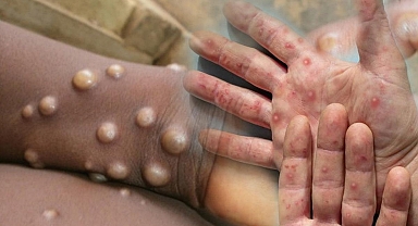 DSÖ'den M çiçeği virüsü uyarısı: Salgın kıtayı aştı! 'Kontrol altına alınmalı'