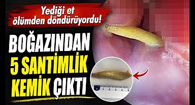 Yediği et ölümden döndürüyordu! Boğazından 5 santimlik kemik çıktı