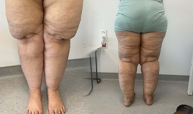 Herkes kilo problemi olarak görüyor: Lipodem nedir?