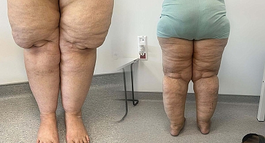 Herkes kilo problemi olarak görüyor: Lipodem nedir?